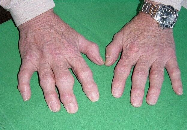 Hatzetako artrosia