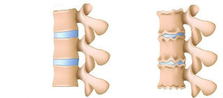 Osteokondrosia garatzeko mekanismoa