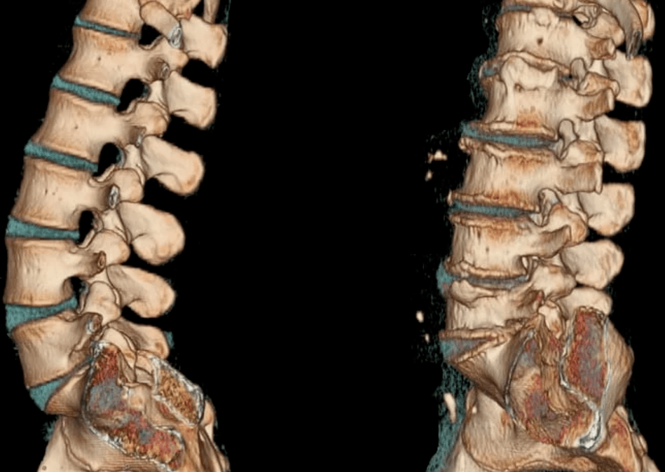 Osteokondrosia