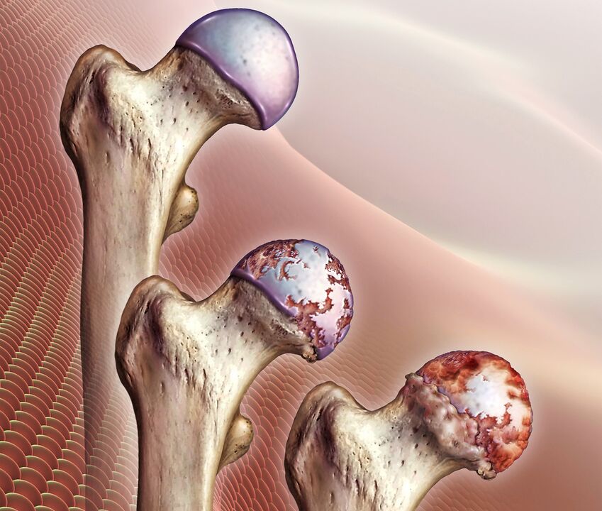 Hip artikulazioko artrosiaren garapena