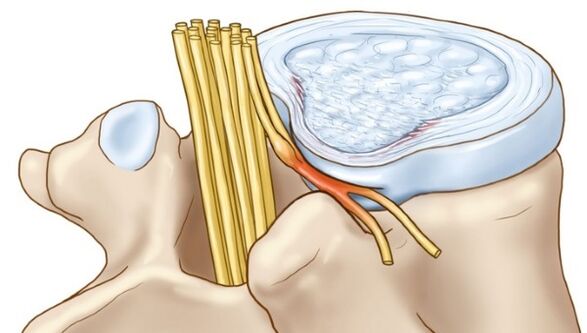 Lumbar osteocondrosis orno arteko hernia moduan konplikazioak ekar ditzake